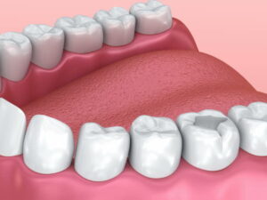Diş dolgusu yapan dişçiler