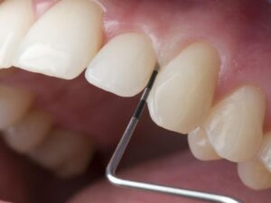 Muş Diş Eti Tedavisi