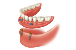 Muş Protez Diş Yapımı