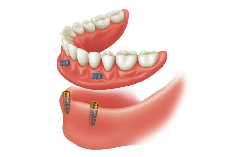 Muş Protez Diş Yapımı